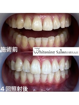 ホワイトニングサロン 京都烏丸店/ホワイトニング施術例