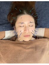 こじま 富雄団地接骨院/ヒト幹細胞美容鍼