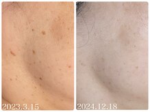 フォーチューン/シミの改善ケア