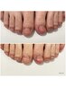 【女性/フット】素足で過ごしたくなる解放感！深爪矯正コース/体験￥24,200→