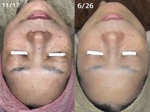 ベル(Belle)/シミケアハーブピーリング¥9,800