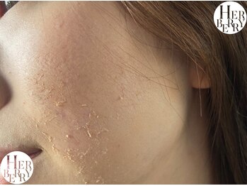 ハーバリー ハーブピーリング 金山店(HERBERRYハーブピーリング)/ハーブピーリング専門店HERBERRY