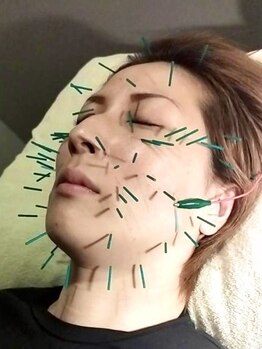 アンソル(&SOL)の写真/ヘッド・フェイスに美容鍼からパルスで刺激し、お顔の筋肉をほぐして「休むこと」も大切な仕事。