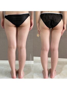 トータルビューティーサロンリア(Li'a)/美脚/浮腫/歪み/O脚改善に