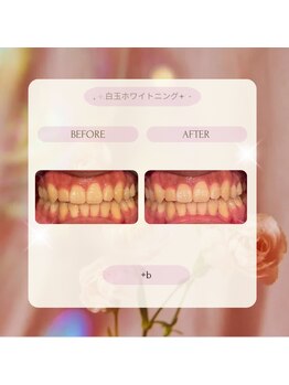 プラスビー 2号店(+b)/ホワイトニングビフォーアフター
