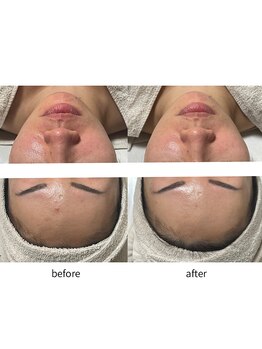 ルアラナ(Lualana)/ハーブリプロ1回施術20日後変化