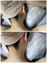 ルルトウキョウ 池袋店(LULU.tokyo)/うなじ脱毛