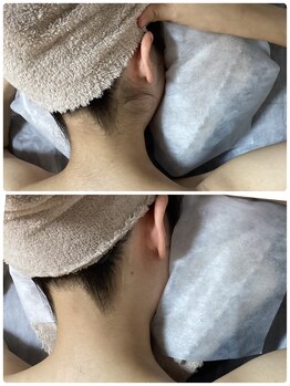 ルルトウキョウ 池袋店(LULU.tokyo)/うなじ脱毛