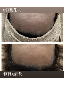 リバイセリー(Revicelly)/比較写真