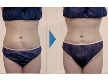 美レーサー(Bellezza)の雰囲気（ラジオ波を使って代謝をアップむくみも解消☆）
