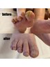 【変形爪・分厚い爪の爪切り&補正】