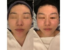 ナラビューティー(NARA BEAUTY)/コルギ1回効果