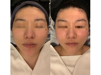 ナラビューティー(NARA BEAUTY)/コルギ1回効果