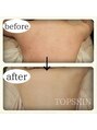 トップスキン 名駅(TOPSKIN)&nbsp;TCLINEハーブピーリングは背中ニキビやざらつき、しみも得意です