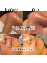 モンド(Mondo)/毛穴洗浄