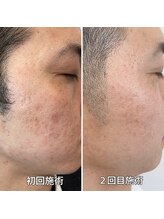 男のカラダビューティー/ニキビ改善/美肌