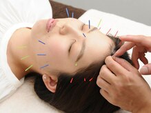 やけの鍼灸整骨院/変化が体感できる美容鍼◎