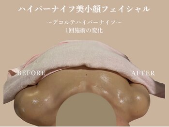 エステティックサロン アールグレー 名古屋駅店/ハイパーナイフデコルテ1回.変化