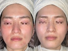 ルオン(Luon.)の雰囲気(合わない化粧品で赤く荒れた肌…乳酸菌ピーリングでより綺麗に!)