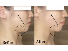 リィ プラス(Riii plus)の雰囲気（即効性抜群！リフトアップ、小顔も◎【ラフォスプレミアム】）