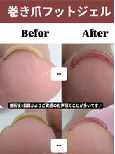 レヴィア 大垣店(Levia)/巻き爪フットジェル