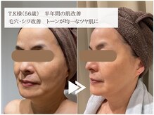 レイテノール 藤沢店/50代半年間でツヤ肌に