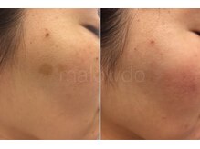マロウド 藤枝店(malowdo)/【短期集中】しみケアプログラム