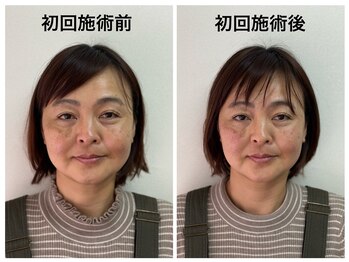 トータルバランス整体院 &nbsp;オレンジ(ORANGE)/小顔矯正/エラ張り/頬骨膨らみ