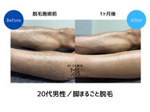 メンズアメリ/高知/メンズ脱毛/ヒゲ/全身/VIO
