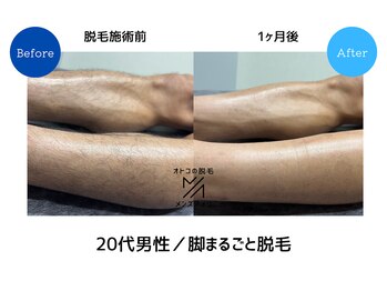 メンズアメリ/高知/メンズ脱毛/ヒゲ/全身/VIO