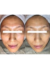 フィエルテ(Fielte)/小顔/くすみ/ハリ