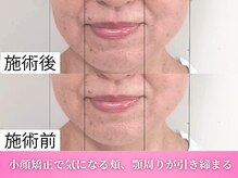 ワト(WATO)/■小顔施術（before→after)