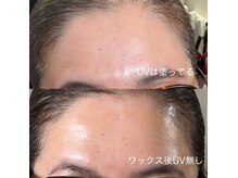 アンド(and...)/肌質改善・毛穴・産毛ケア