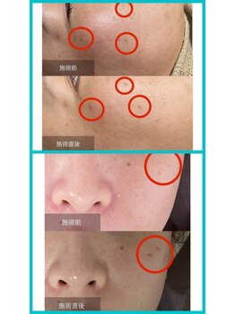 アルマサロン 菊陽(Almasalon)/シミケア