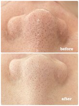 ピアーノ(PIANO)/エルモサハーブピーリング