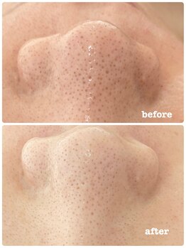 ピアーノ(PIANO)/エルモサハーブピーリング