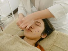 アキュネ 福岡薬院店(acune)/福岡/薬院/美容鍼/美肌