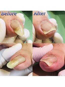 巻き爪補正店 湘南辻堂店/巻き爪・補正例