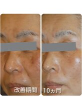 エヌミー(N me)/シミ改善結果