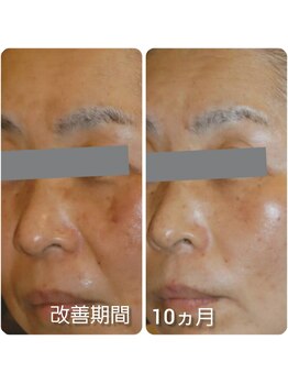 エヌミー(N me)/シミ改善結果