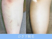 オーシャンブルー 大分店(OCEAN BLUE)/ひざ下脱毛