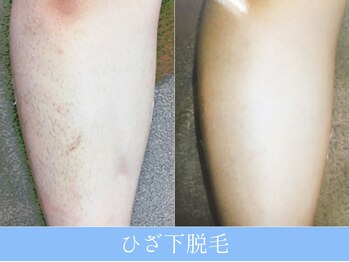 オーシャンブルー 大分店(OCEAN BLUE)/ひざ下脱毛