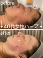 ヒュッゲサロン(HYGGE Salon)&nbsp;【50代女性】ハーブでのお肌の変化！引き締まり小顔&美白に◎