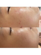 クウラ 学園前店(KUULa)/ニキビ肌さようなら！