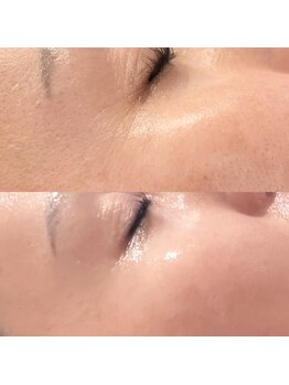 ミニョンボーテ(mignon beaute)/before/after 40代