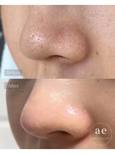 アエ(ae)/ダクトピール