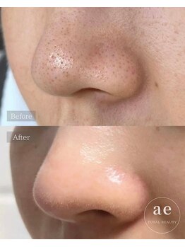 アエ(ae)/ダクトピール