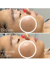 アウラ(AURA)/ダクトピール2回目です