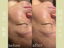 健志接骨院/πテラピーで肌質改善