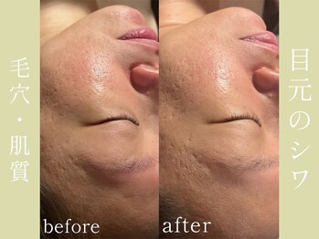 健志接骨院/πテラピーで肌質改善